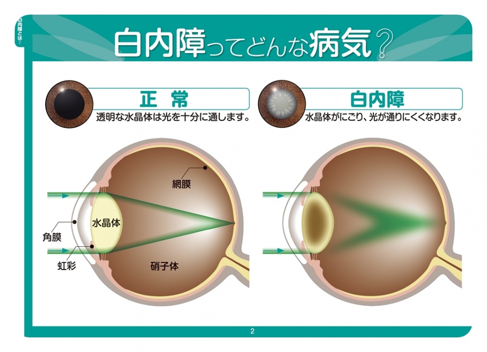 白内障 手術 乱視 に なっ た