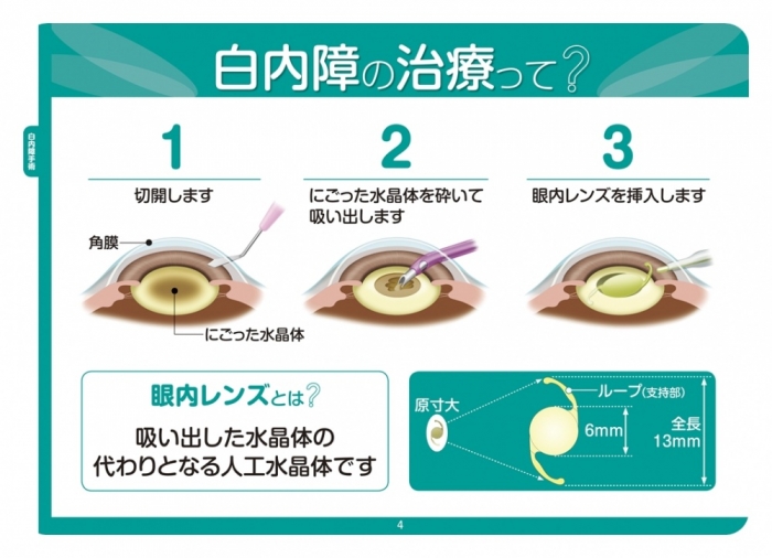 白内障 手術 レンズ の 選び方